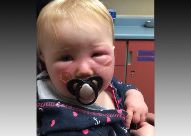 Αντηλιακό «για παιδιά» προκάλεσε ΑΥΤΟ σε μωρό 1 έτους – Προσοχή στα αντηλιακά! [vid, pics]