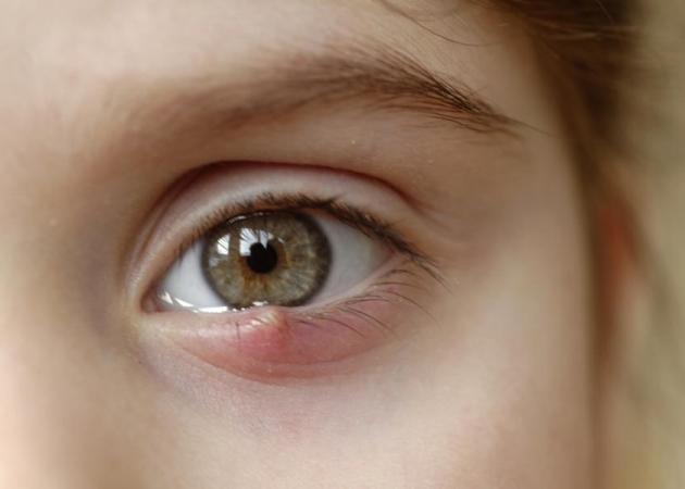 Τι να κάνεις για το κριθαράκι στο μάτι – Θεραπείες και πρόληψη