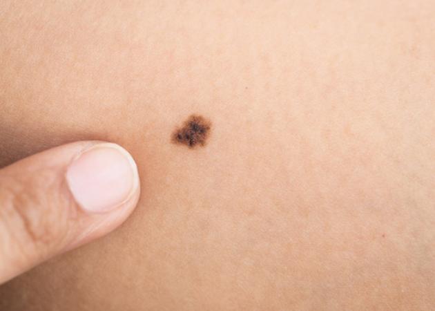 Ελιές στο δέρμα: Αυτά είναι τα 5 σημάδια που δείχνουν κίνδυνο για καρκίνο