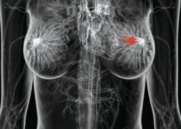 Νέα θεραπεία για το μεταστατικό καρκίνο του μαστού