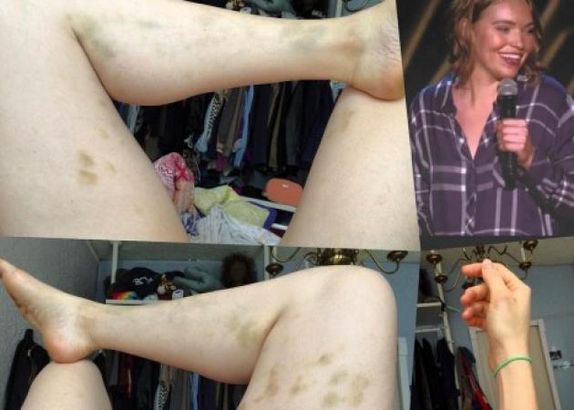 Σοκαριστική φωτογραφία ηθοποιού – Την έδερνε και τη βίασε ο φίλος της