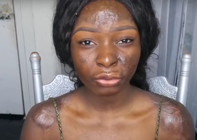 Συγκλονίζει η blogger που κάηκε στο πρόσωπο και ανεβάζει βίντεο με μακιγιάζ!