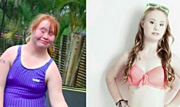 Έφηβη με σύνδρομο Down, έχασε 20 κιλά, ασχολείται με το modeling κι ελπίζει στον επαναπροσδιορισμό της ομορφιάς! Φωτό