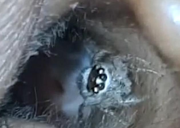 Η… ανατριχιαστική στιγμή που μια αράχνη βγαίνει από το αυτί γυναίκας! Είχε πάει στο γιατρό με πονοκέφαλο! Video
