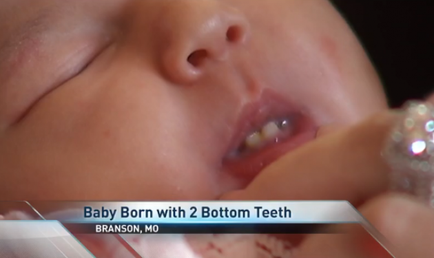 Mωρό γεννήθηκε με δυο μπροστινά δόντια! Φωτό και βίντεο