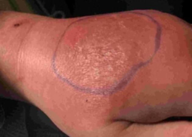 Τσίμπημα αράχνης: Πώς θα προφυλαχθείς σωστά