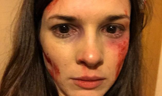 Με μώλωπες και αίματα στο πρόσωπο η Ευγενία Δημητροπούλου – Τι συνέβη στην ηθοποιό