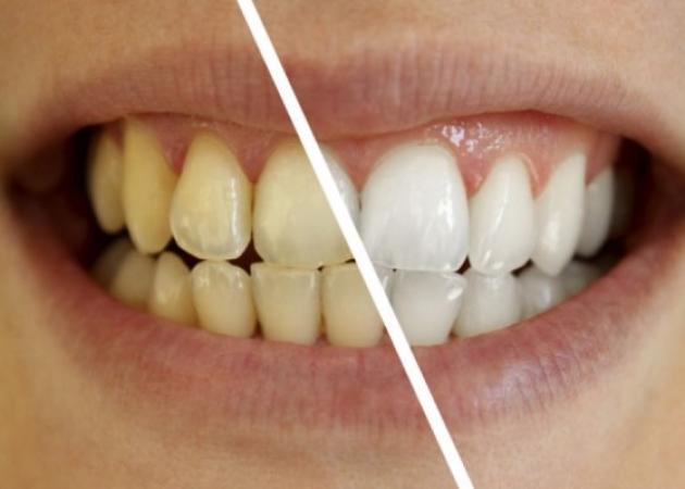 Το “μαγικό” διάλυμα για πιο αστραφτερά δόντια με το βούρτσισμα!