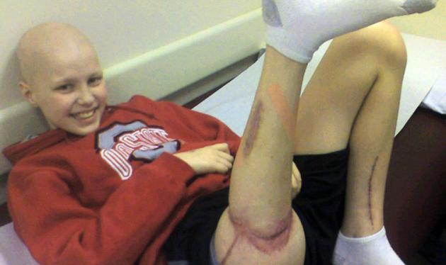 Οι γιατροί έβαλαν ανάποδα το πόδι 13χρονου για να τον σώσουν απ΄τον καρκίνο!