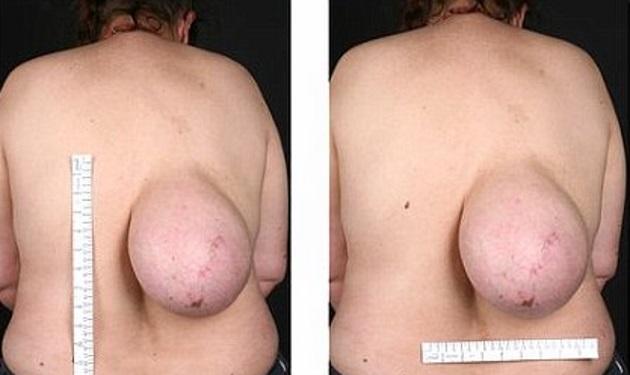 Η γυναίκα με το “στήθος” στην πλάτη! Της αφαίρεσαν όγκο δέκα ετών