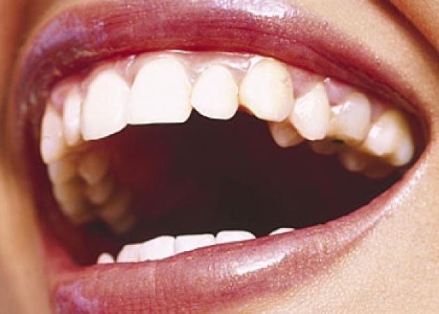 Λευκά σημάδια στα δόντια: Πού οφείλονται – Τι πρέπει να κάνεις