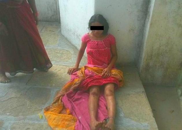 Φρίκη στην Ινδία – Εκδικήθηκαν την δεύτερη σύζυγο καίγοντας τα γεννητικά της όργανα!