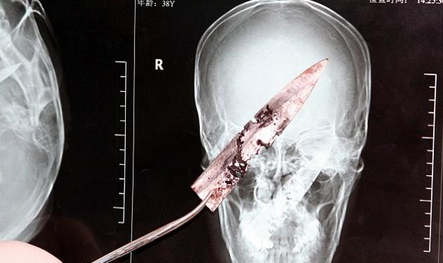 Πήγε στο γιατρό με πονοκέφαλο και ανακάλυψε ότι είχε μαχαίρι στον εγκέφαλο!