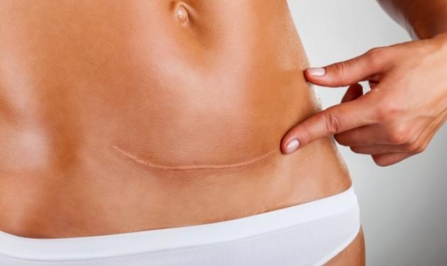 Τι ισχύει για την κοιλιοπλαστική σε συνδυασμό με την καισαρική τομή – Πότε μπορεί να γίνει