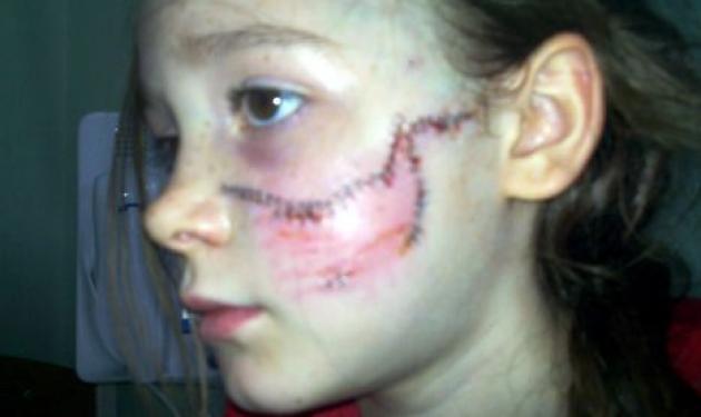 Σοκ! 8χρονη έκανε 175 ράμματα μετά από επίθεση σκύλου!