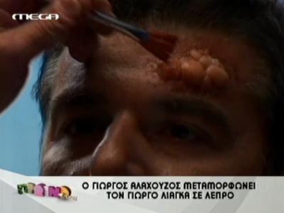 Η μεταμόρφωση του Γ. Λιάγκα σε λεπρό!