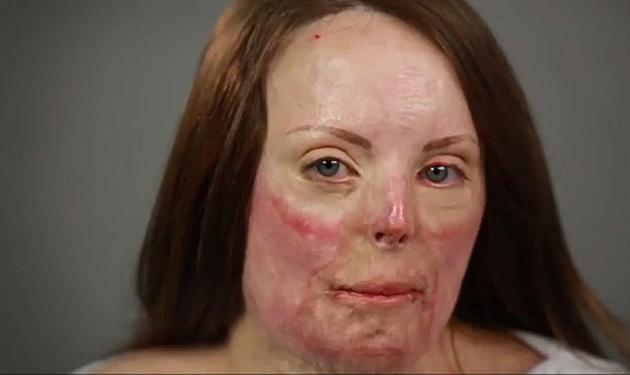 Tα αληθινά θαύματα του μακιγιάζ – Πώς μεταμορφώνεται γυναίκα που κάηκε σε τροχαίο!
