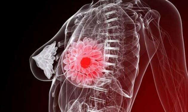 Μεγάλη ανακάλυψη για τον καρκίνο του στήθους – Τι βρήκαν οι επιστήμονες