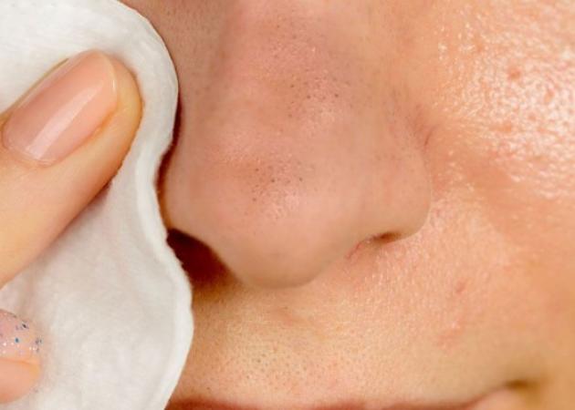 Επιδερμίδα – σπυράκια: Έτσι θα βγάλεις τα μαύρα στίγματα με φυσικό τρόπο