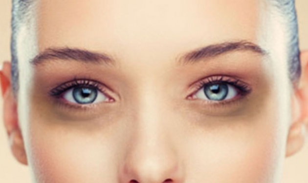 Οι Top – 3 σπιτικές λύσεις για να σβήσεις τους μαύρους κύκλους στα μάτια
