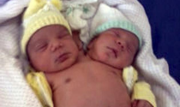 Μωρό με δυο κεφάλια γεννήθηκε στη Βραζιλία