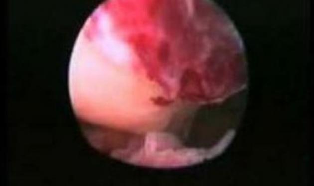 Για πρώτη φορά καταγράφεται η ανθρώπινη ωορρηξία – Βίντεο