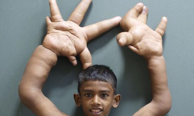 Tο αγόρι με τα μεγαλύτερα χέρια στον κόσμο!