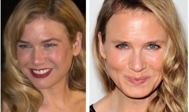 Renee Zellweger: Στη βλεφαροπλαστική οφείλεται τελικά η αλλαγή στο πρόσωπό της;