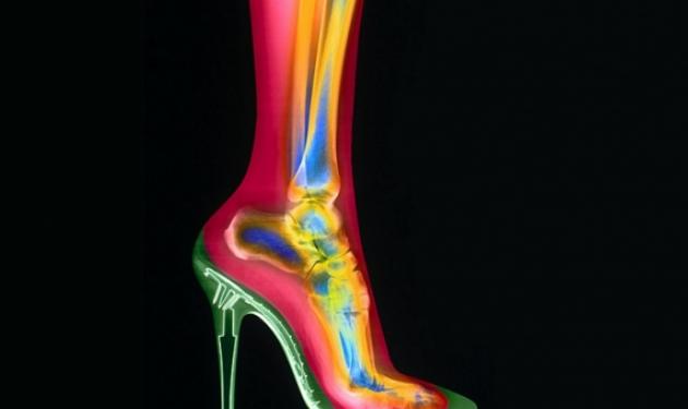 Το πόδι της γυναίκας με ψηλοτάκουνα παπούτσια! Φωτογραφίες με ακτίνες Χ