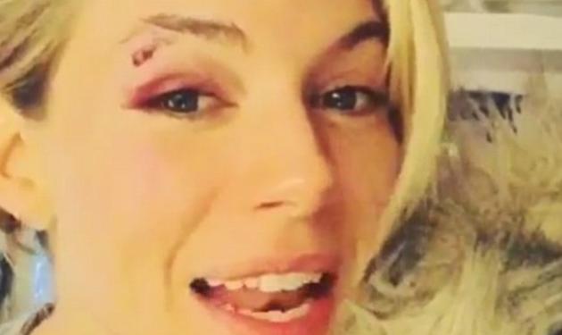 Sienna Miller: Με μαυρισμένο μάτι και ράμματα ανέβασε βίντεο και φωτογραφίες στο instagram!