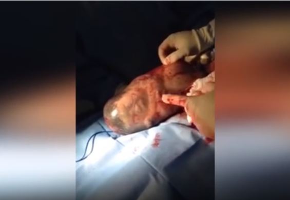 Συγκλονιστικό βίντεο: Γέννηση μωρού που είναι ακόμα μέσα στον αμνιακό σάκο!