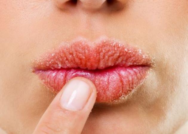 Χείλη σκασμένα από το κρύο: Δες τι μπορείς να κάνεις