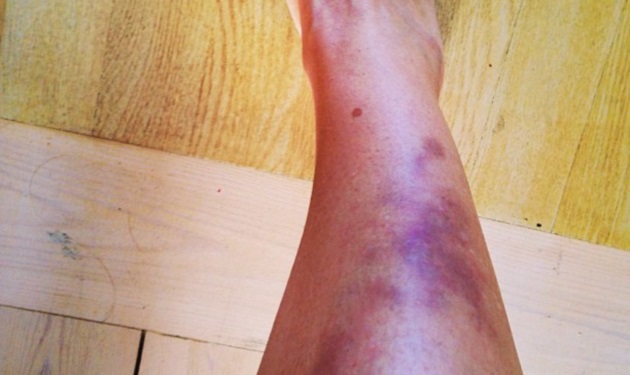 Ποιος χτύπησε την Αλεξάνδρα Πασχαλίδου; Φωτογραφία με το μελανιασμένο πόδι της