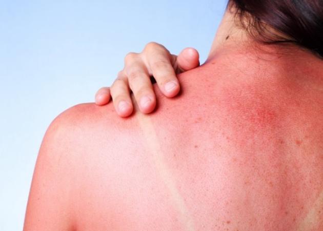 Έγκαυμα από ήλιο: Τα σωστά βήματα για θεραπεία και ανακούφιση [vid]