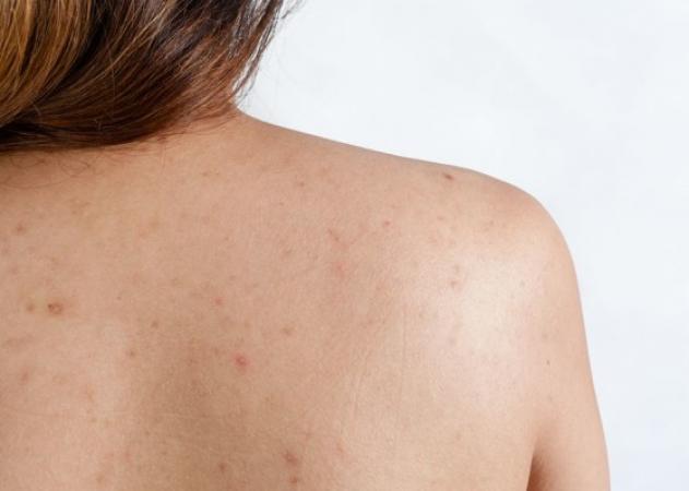 Σπυράκια στην πλάτη: Πώς μπορείς να απαλλαγείς – Τι προϊόντα να βάλεις
