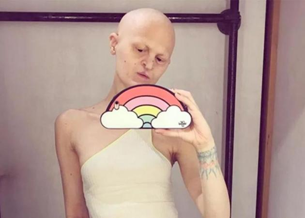 Μοντέλο με σπάνια γενετική ασθένεια σπάει τα ταμπού στην μόδα – Από τι πάσχει και τι δηλώνει [pics,vid]