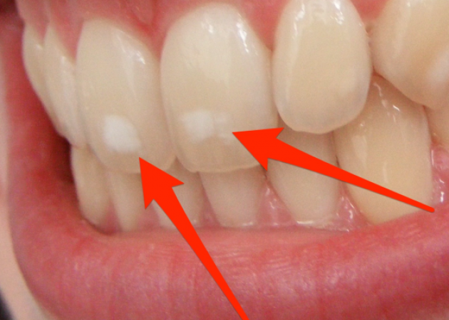 Πού οφείλονται ΑΥΤΑ τα λευκά σημάδια στα δόντια – Τι πρέπει να κάνεις