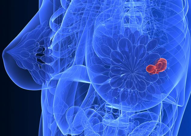 Καρκίνος του μαστού: Διπλάσιος ο κίνδυνος για τις γυναίκες με πυκνό μαστό