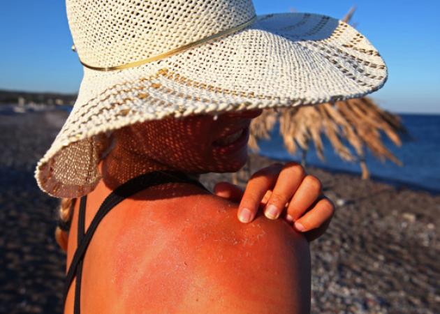 Ηλιακό έγκαυμα: Γιατί προκαλεί φαγούρα και πώς σταματάει