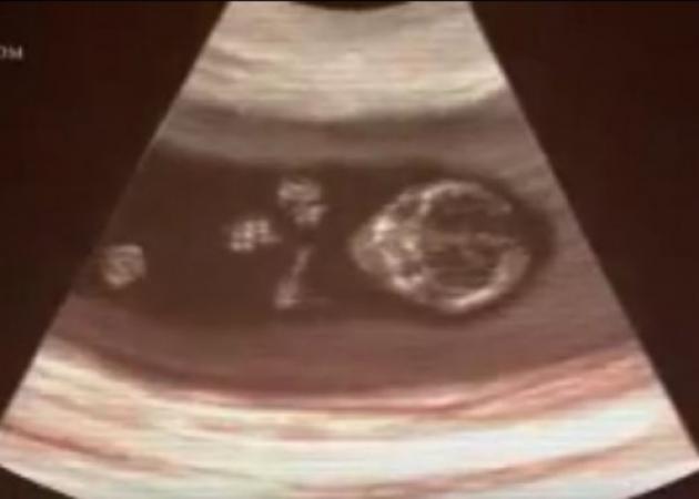 Έκανε άμβλωση και λίγους μήνες μετά γέννησε το παιδί της