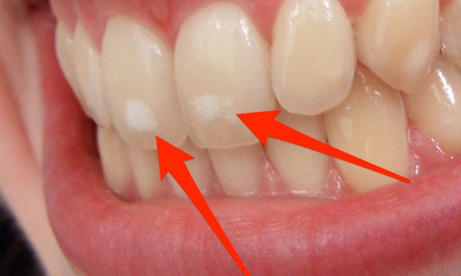 Πού οφείλονται ΑΥΤΑ τα λευκά σημάδια στα δόντια – Τι πρέπει να κάνεις