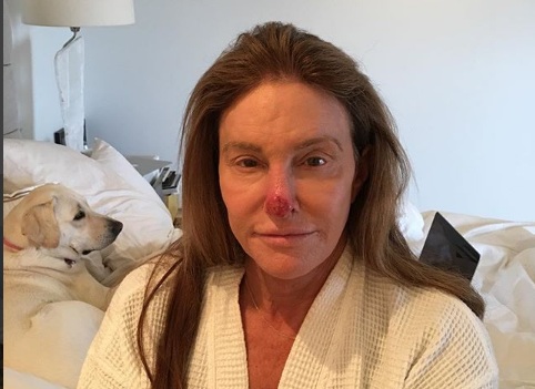 Η Caitlyn Jenner μας δείχνει την επέμβαση στη μύτη για να αφαιρέσει τον καρκίνο! [pic]
