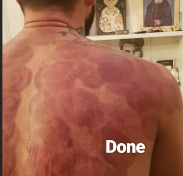 Σε ποιον διάσημο Έλληνα μόλις έκαναν… βεντούζες; Καρέ καρέ η διαδικασία [pics]