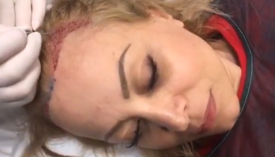 Η Τέτα Καμπουρέλη έκανε εμφύτευση μαλλιών και το κατέγραψε στην κάμερα! video