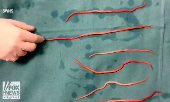 Της έβγαλαν 14 σκουλήκια από την χολή – Ανατριχιαστικό βίντεο [vid]