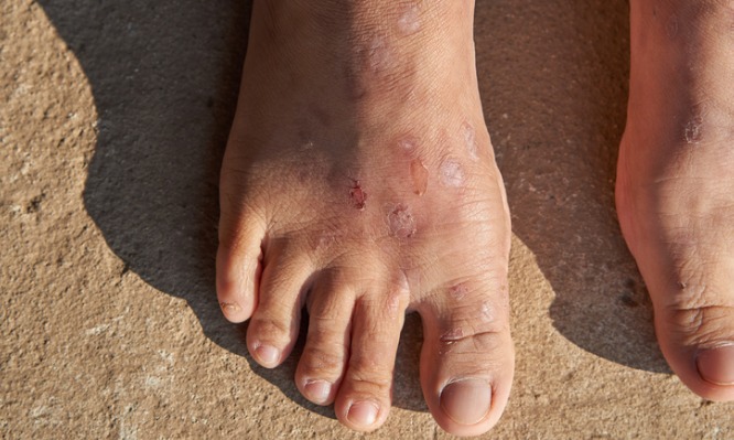 Δερματίτιδα: Πώς θα προλάβετε το έκζεμα από τον καλοκαιρινό ήλιο