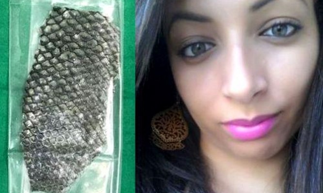 Γεννήθηκε χωρίς κόλπο – Οι γιατροί της έφτιαξαν έναν από… πέτσα ψαριού! [vid]