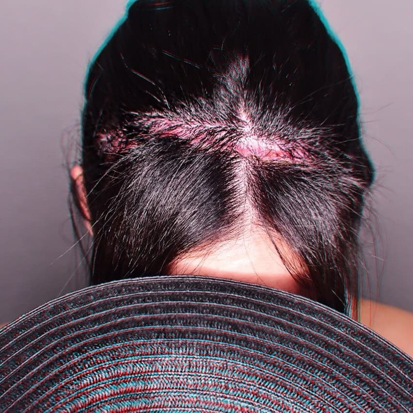 Η Ανθή Βούλγαρη μας δείχνει τα σημάδια από την κρανιοτομή και δίνει το μήνυμά της! [pics]