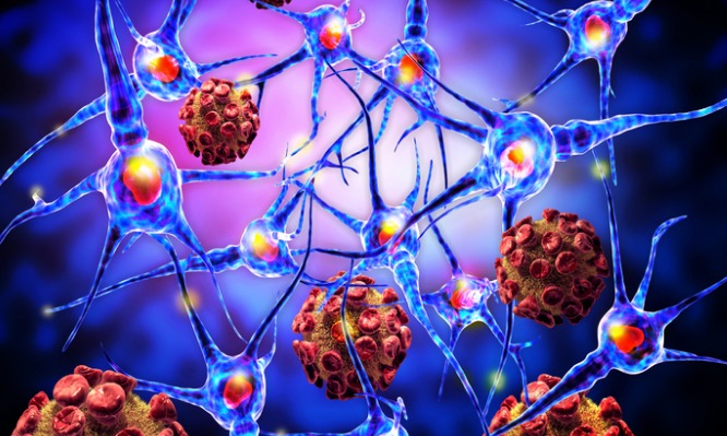 Τα 8 πιο απίθανα συμπτώματα στην Σκλήρυνση κατά Πλάκας – Μην τα αγνοείτε!