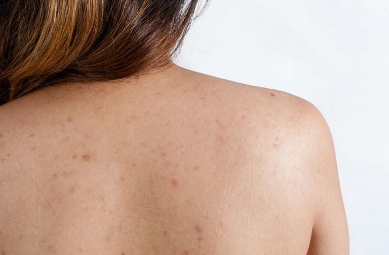 Τι να κάνεις για τα σπυράκια στην πλάτη λόγω ζέστης και ιδρώτα το καλοκαίρι